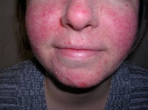 Eczema How To Treat When On Face Facial Eczema Eczema Eczema Treatment