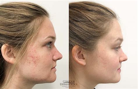 Accutane Before And After Body