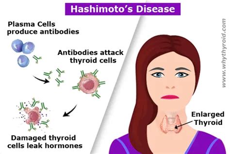 Hashimotos Disease Causes Symptoms Diagnosis Treatment Why Thyroid
