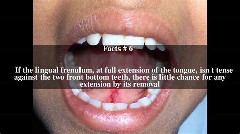 Lingual Frenectomy Top 10 Facts Youtube