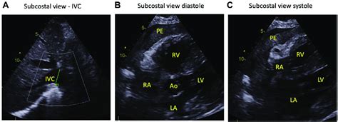 Echocardiographic Images Of The Subcostal Views Of The Heart Chambers