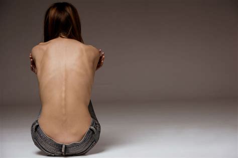 Fotografías De Ivonne Thein Que Retratan La Anorexia