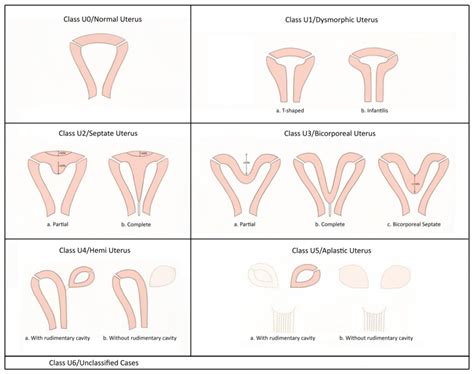 Eshre Esge Classification Of Uterine Anomalies Adapted From