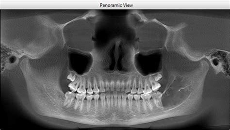 Cysts Of The Jaw Dr Khaled Amin Tarboush Dds Ms Cags