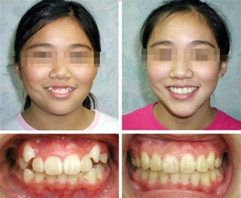 จัดฟันช่วยหน้าเรียว ดั้งโด่งจริงหรือไม่ หมอฟันแจงดังนี้