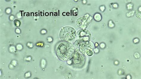 Renal Epithelial Cells In Urine