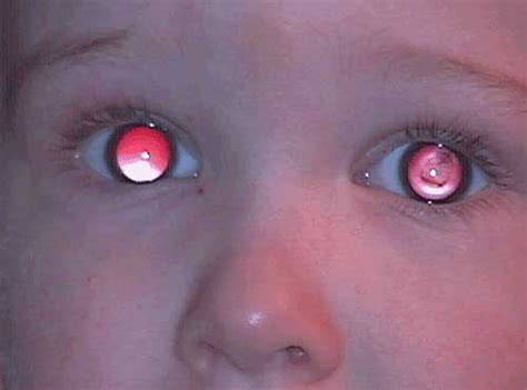 Seeing Red Why Kids Need Red Reflex Exams