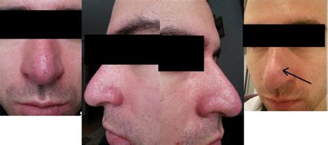 Laser Surgery On Nose Bumps + Rosacea Treatment (Ktp + Co2 Laser