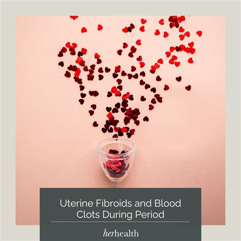 Uterine Fibroids And Blood Clots During Period