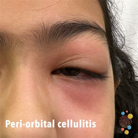 Peri Orbital Cellulitis Skin Deep