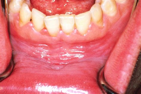 Gum Boils What They Are What Causes Them And What To Do About Them