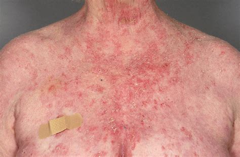 Pemphigus foliaceus is an autoimmune disease that causes itchy blisters to form on your skin. Pemphigus Foliaceus (including fogo selvagem ...