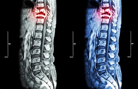 What Are The Different Types Of Minimally Invasive Spine Surgery