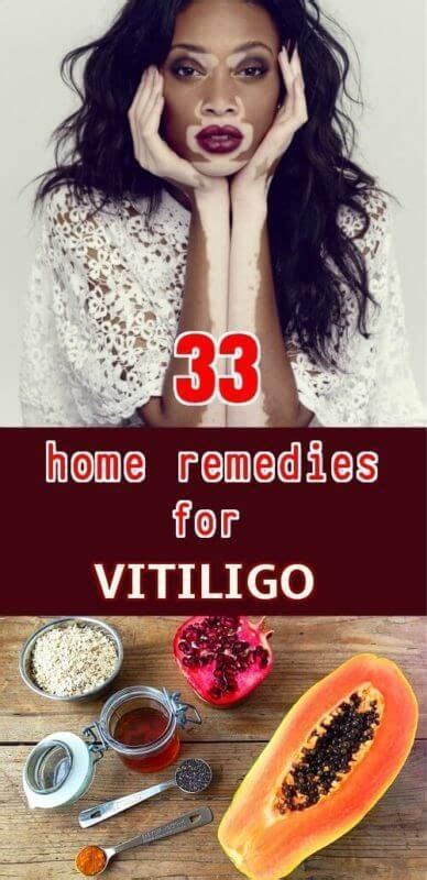 Home Remedies To Get Rid Of Vitiligo Vitiligo Treatment Vitiligo