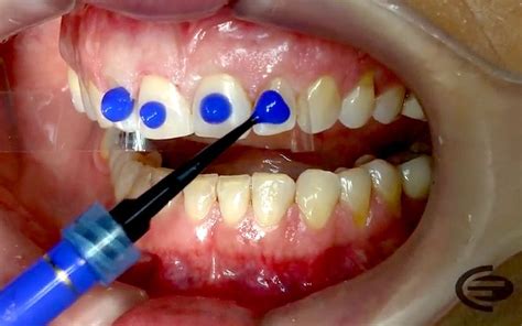 Operatoria Dental Reconstrucción Con Composites Dra Rathman