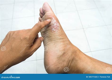 Infected Athlete Foot Stock Image Image Of Athlete 185771425