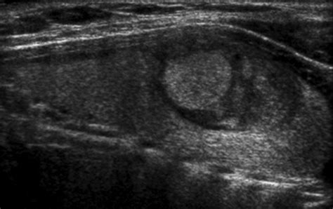 Sonographic Appearance Of Thyroid Cancer In Patients With Hashimoto