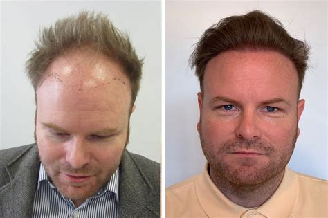Haartransplantation vorher & nachher Bilder