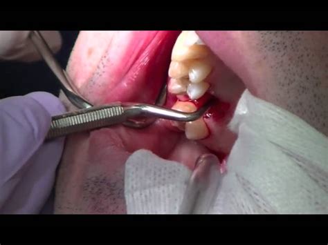 How To Pull A Molar Out Painlessly