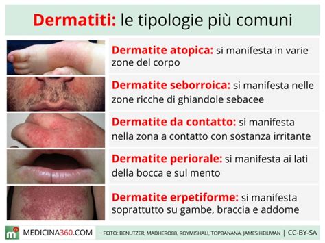 Dermatite Cause Sintomi Cure E Tipi Atopica Seborroica
