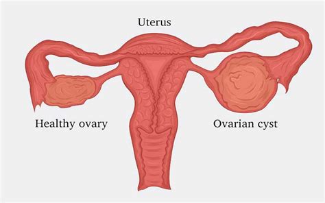 different types of ovarian cysts