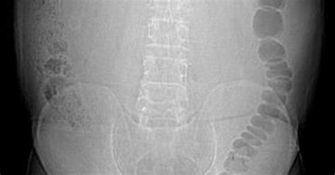 Diffuse Intrabdominal Lipomatosis Intraperitoneal Lipomatosis Uncommon