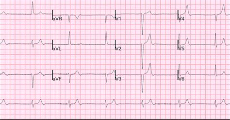 Sinus bradycardia secondary to anorexia nervosa. Dr. Smith's ECG Blog: Bradycardia