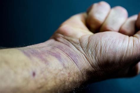 Fist Closed Man`s Arm With Bruises On His Hand And Wrist Stock Photo