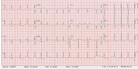 Preoperative Atrial Fibrillation And T Wave Inversion Associated With