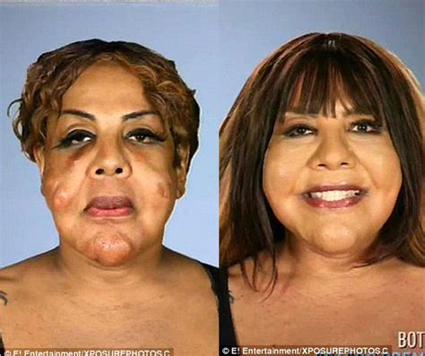 Transgender Rajee Narinesingh Has Cement In Face Finally Removed Naija Blog Queen Olofofo
