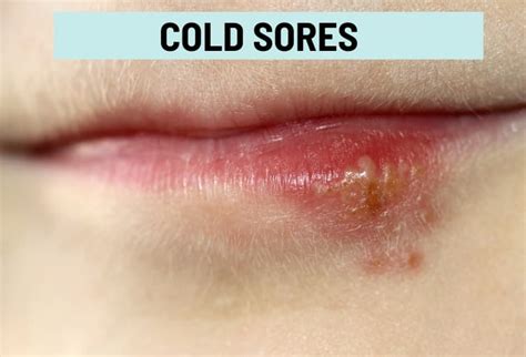 Cold Sores Causes Treatment And Fever Blisters Vs Cold Sores