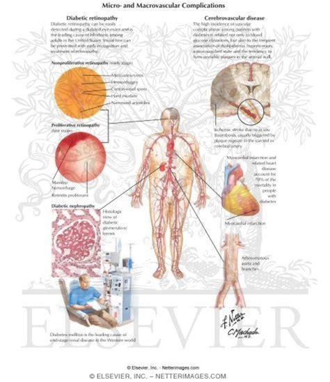 Diabetes Mellitus And Its Complications Micro And Macrovascular