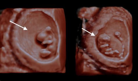 Nine week pregnancy symptoms can hit you like a ton of bricks. Scan of the Week: 9 Week Old Baby Scan - Ultrasound Scan ...