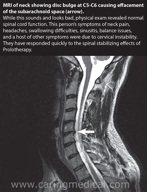 Cervical Disc Disease And Difficulty Swallowing Cervicogenic