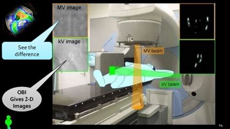 Image Guided Radiation Therapy Igrt