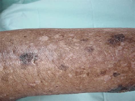 Multiple Dark Brown Hyperkeratotic Plaques On The Lower Limbs