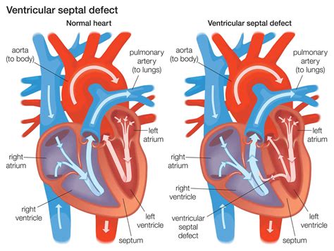 Ventricular Septal Defect Causes Types Symptoms Diagnosis Treatment Prognosis