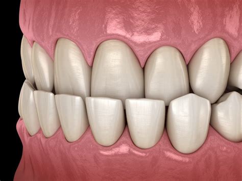 What Is Malocclusion And How Does It Affect Your Oral Health West