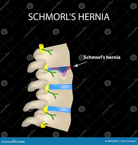 Hernia Schmorl Intervertebral Disc Side View Spine Infographics