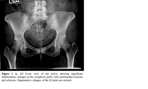 An Unusual Presentation Of Ankylosing Spondylitis Involving The