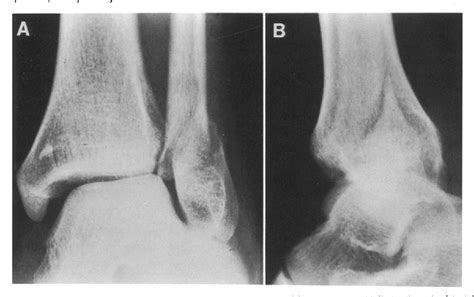 Figure 1 From Distal Tibiofibular Synostosis After Malleolar Fractures