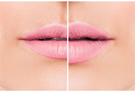 Woman Lips Before And After Lip Filler Injections Fillers Lip Crayon