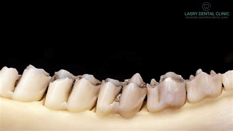 Bone Grafting Price Procedure And Everything You Need To Know