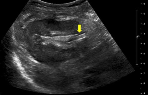 Nephrostomy Tube Ultrasound