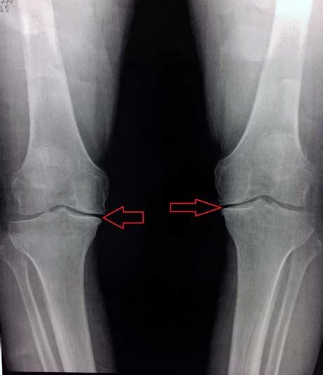 Varus Knee Osteoarthritis Corrective Tibial Osteotomy George D