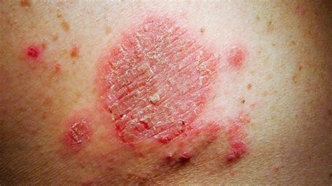 Medicinenet 2021 Itchy Spots On Skin Treatment