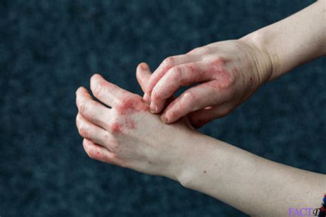Get 34 Dyshidrotic Eczema On Hands Treatment