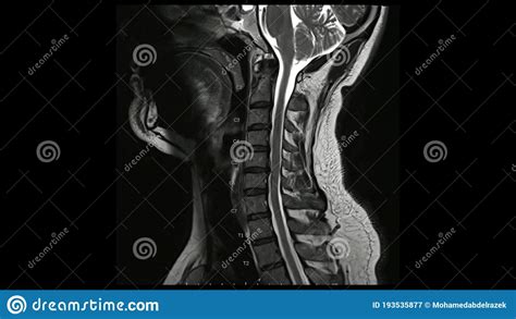 magnetic resonance images  cervical spine sagittal  weighted images
