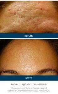 Started losing my hair when i was about 20. Microneedling Treatments in Midtown Atlanta and Alpharetta ...