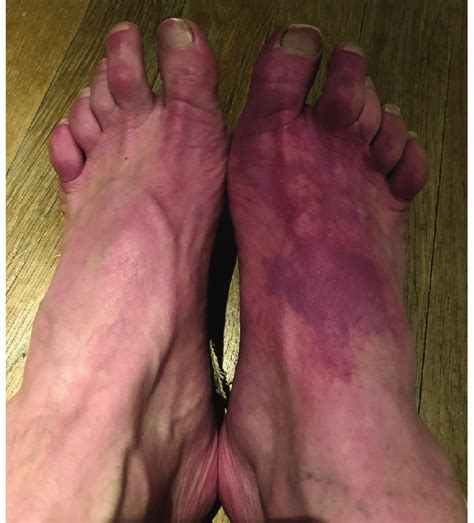 Patchy Purple Discoloration Of The Right Foot During An